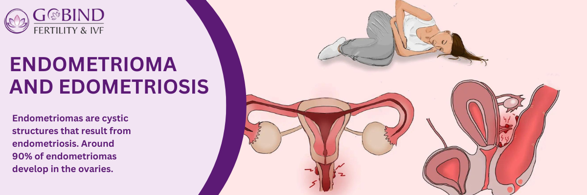 A visual representation of endometriosis and endometritis, highlighting Endometrioma.