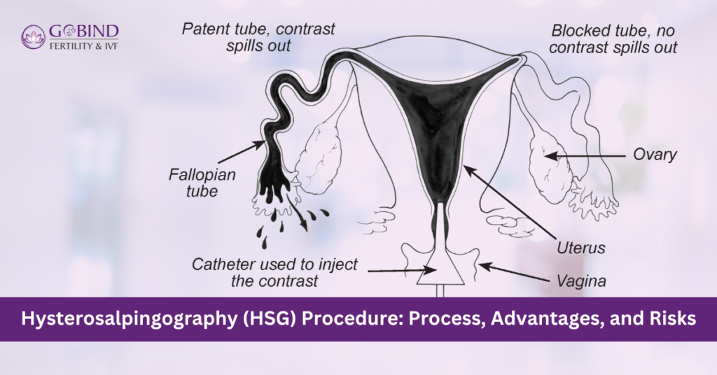 Hysterosalpingography (HSG) Process, Advantages, and Risks 