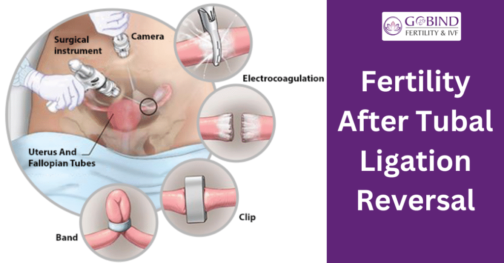 fertility after tubal ligation reversal explained