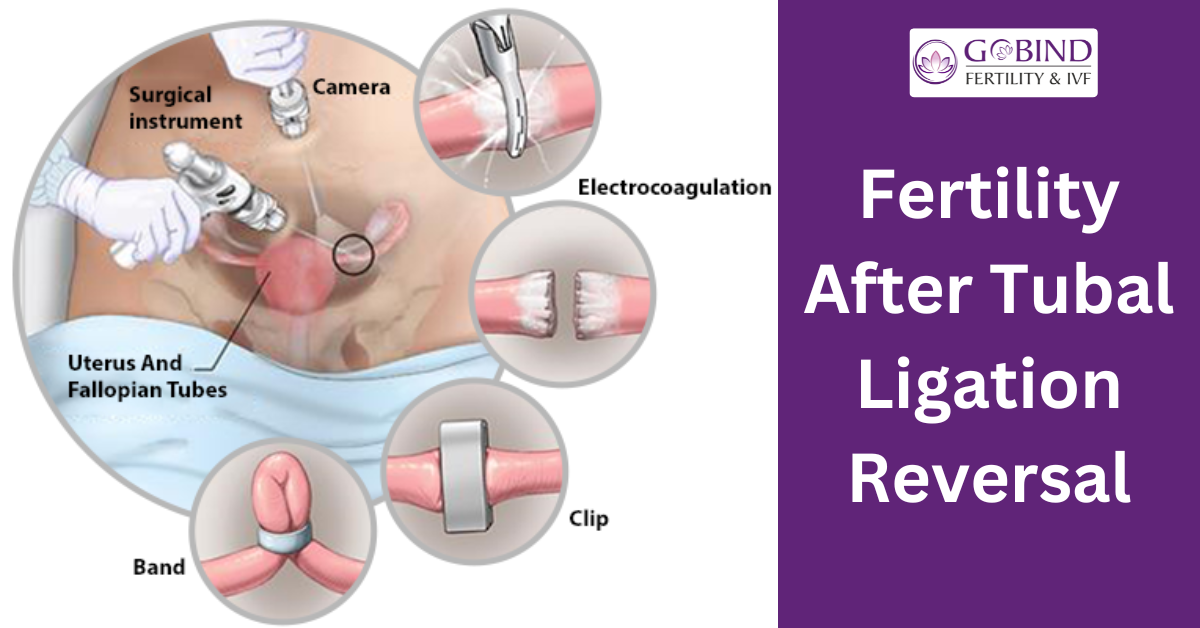 fertility after tubal ligation reversal explained